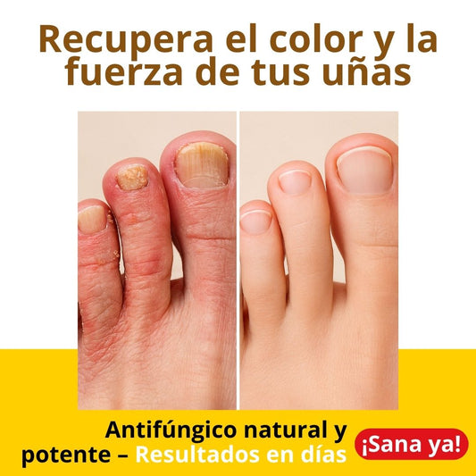 Aceite Ozonizado Doctor Ozono - Tratamiento Antifúngico = 155Mil Gs.